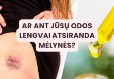 Ant kūno lengvai atsiranda mėlynės - priežastys ir gydymo būdai