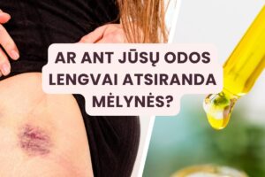 Ant kūno lengvai atsiranda mėlynės - priežastys ir gydymo būdai