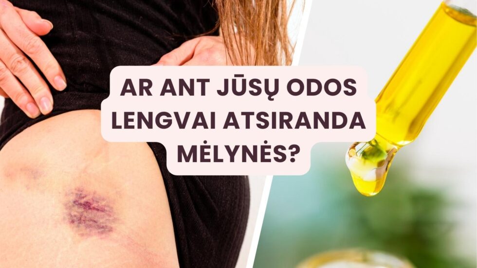 Ant kūno lengvai atsiranda mėlynės - priežastys ir gydymo būdai